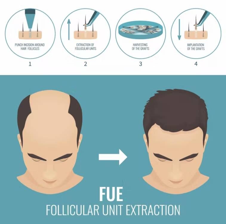 ماكينة زرع شعر من FUE-Micro Mo - مراجعة Hair Care Vegan وسعره